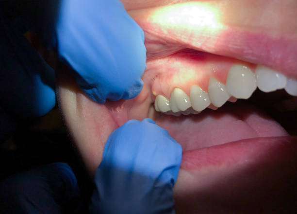 Best Emergency Dentist for Lost Fillings or Crowns in Newpt, OR
